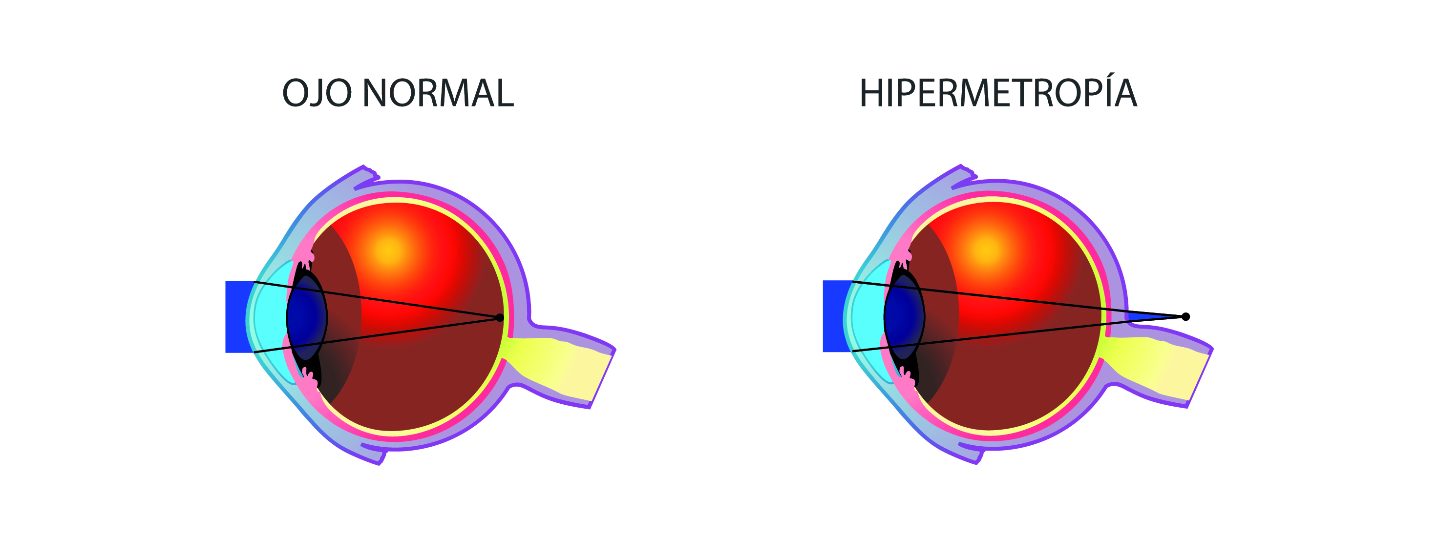HIPERMETROPIA CMYK