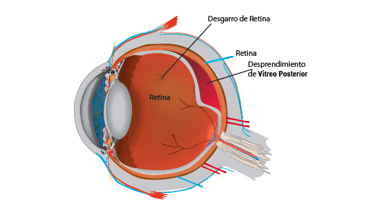 desprendimiento de vítreo ojo