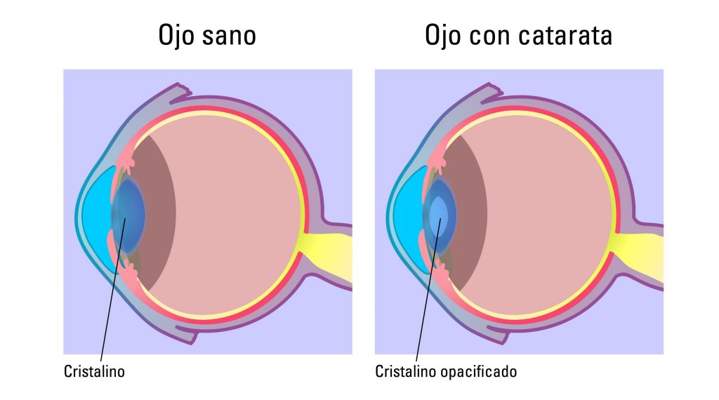 Qué son las cataratas
