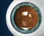 Cirugía refractiva con lente intraocular Mallorca